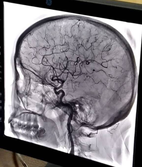 神经内科联合介入中心首次成功开展全脑血管造影术